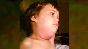 Kerala Mumps