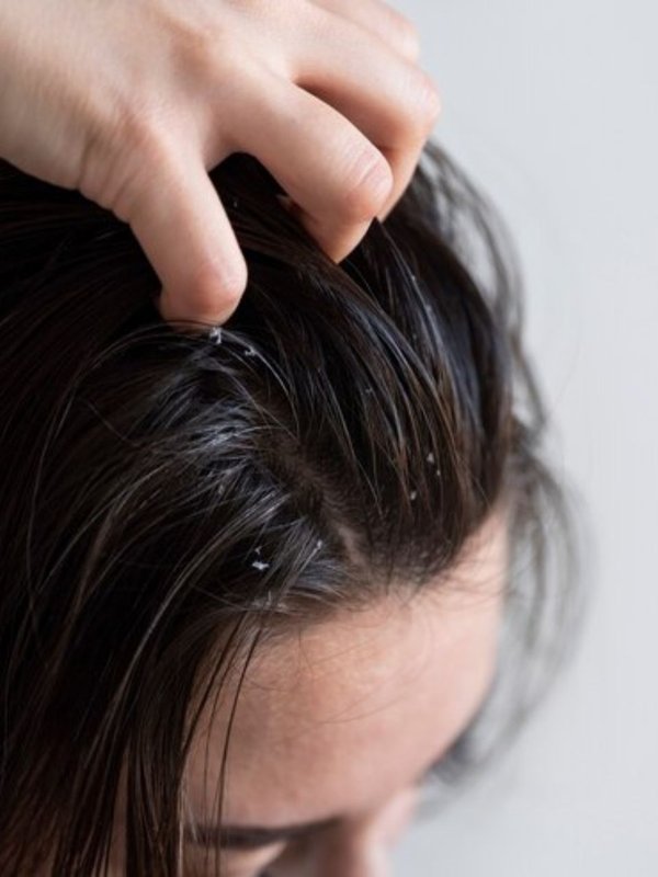 Dandruff Remedy । Hair tips । Hair Care Tips