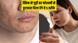 Skin Care । Acne Remedy । How to treat Dull Skin