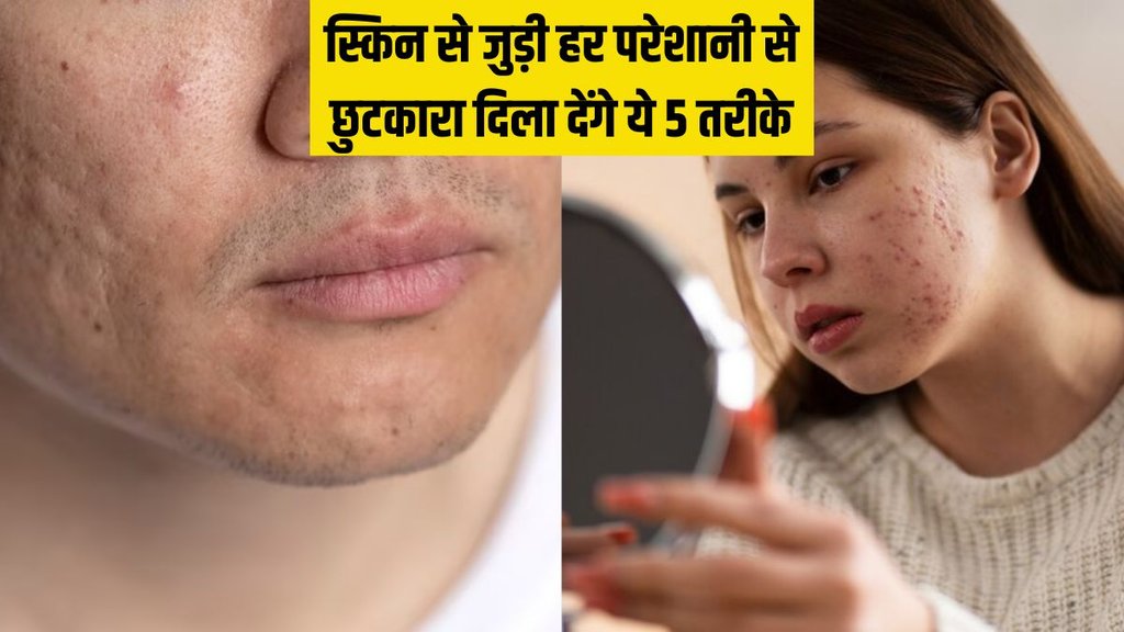 Skin Care । Acne Remedy । How to treat Dull Skin