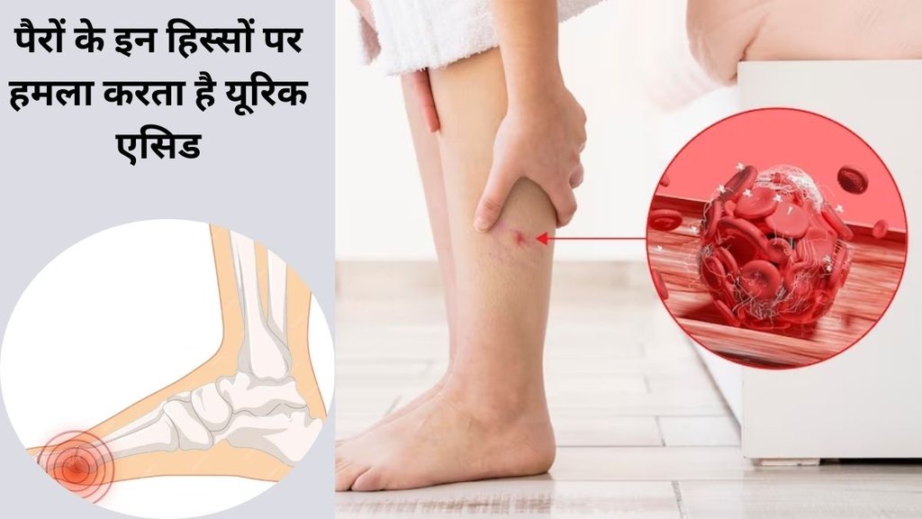 uric acid, uric acid control tips,uric acid control home remedies, how to control high uric acid,Acharya Balkrishna home remedies,how to cure uric acid, uric control tips,gokhru for uric acid control,