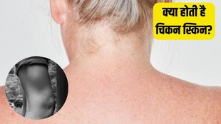 Keratosis Pilaris । Chicken Skin । Skin Care Tips