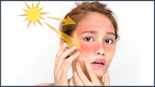 sunburn causes instant relief home remedy
