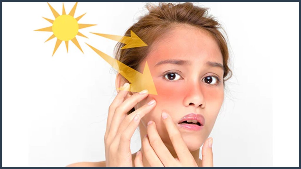 sunburn causes instant relief home remedy