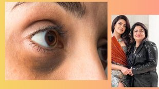 home remedies for under-eye dark circles