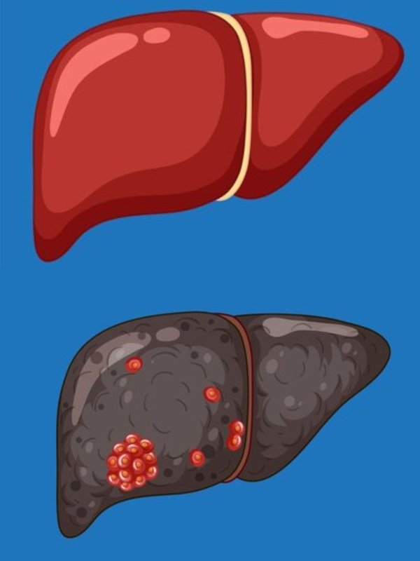 World Liver day । World Liver day 2024 । Liver Health