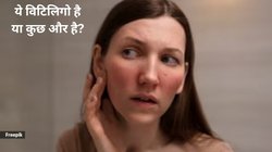 स्किन पर दिखने वाले ये पैच Vitiligo नहीं बल्कि इस 1 समस्या के हैं लक्षण, चेहरे पर दिखने वाले सफेद धब्बों का ये है कारण और उपचार