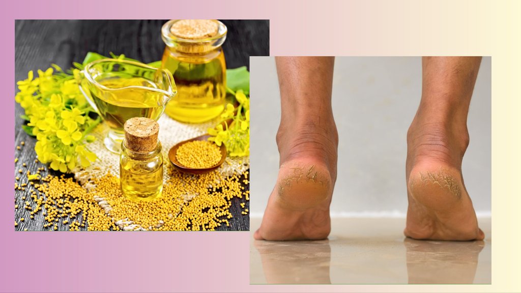mustard oil for cracked heels