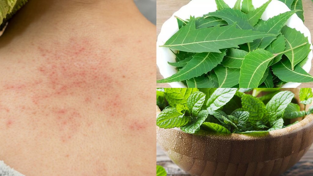 neem and pudina paste for prickly heat