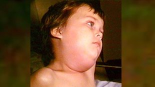Mumps outbreak in Delhi । Mumps outbreak । Mumps symptom