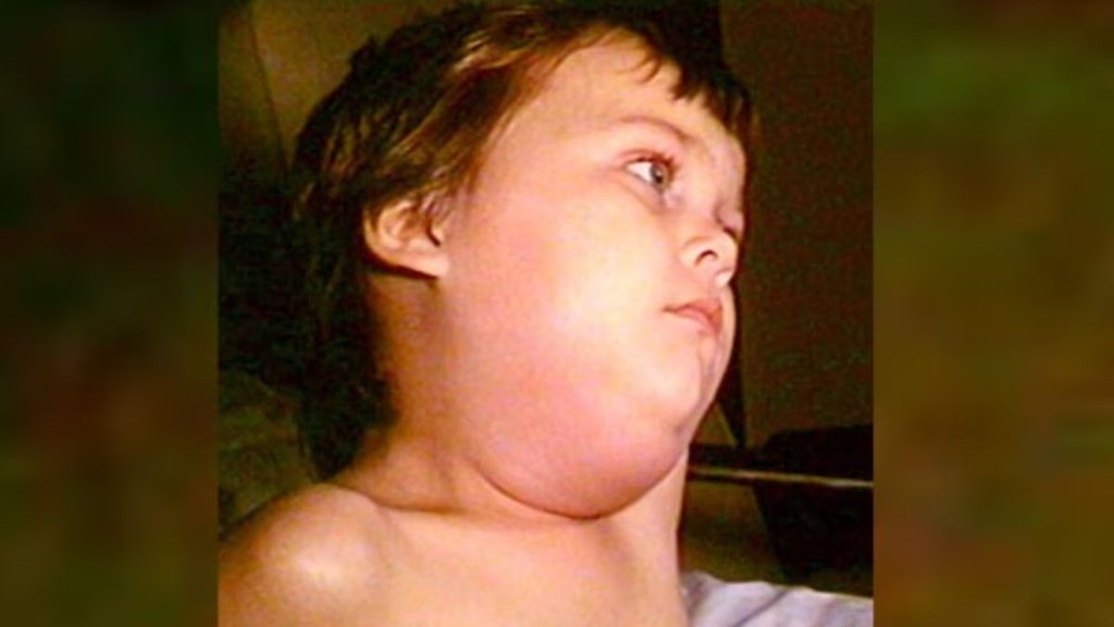 Mumps outbreak in Delhi । Mumps outbreak । Mumps symptom Mumps outbreak in Delhi । Mumps outbreak । Mumps symptom