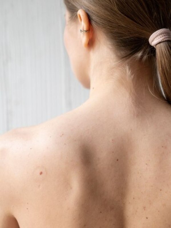 back acne । back acne remedy । back acne treatment