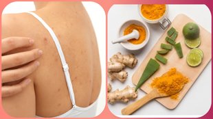 aloe vera with turmeric for back acne