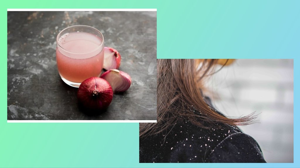 Onion juice for Dandruff Onion juice for Dandruff