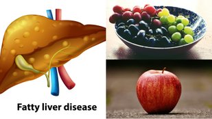 fatty liver