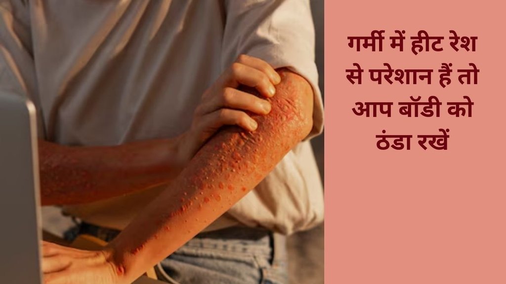 home remedy for prickly heat, how to get rid of prickly heat, ghamori ke upay, ghamori door karne ke upay, summer skin problem, s ummer related skin problem,
