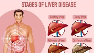 liver decease, avoid these foods for liver health,liver foods to avoid,