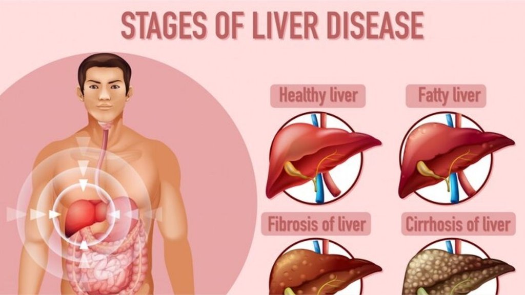 liver decease, avoid these foods for liver health,liver foods to avoid,