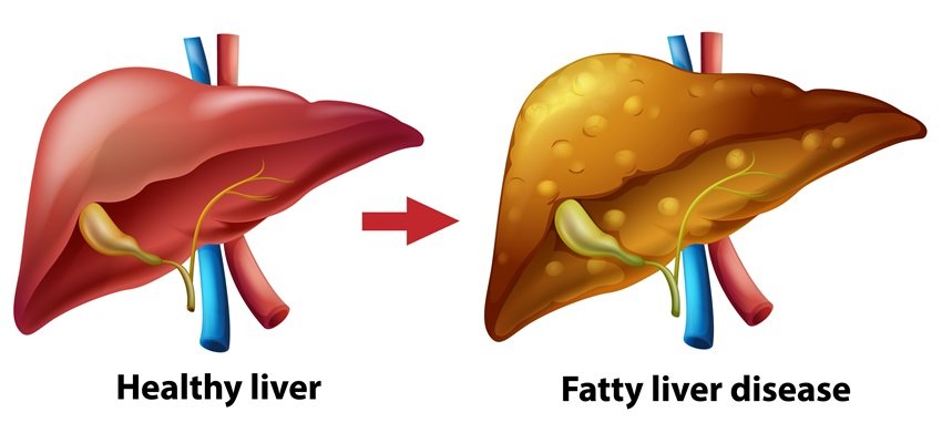 Fatty liver