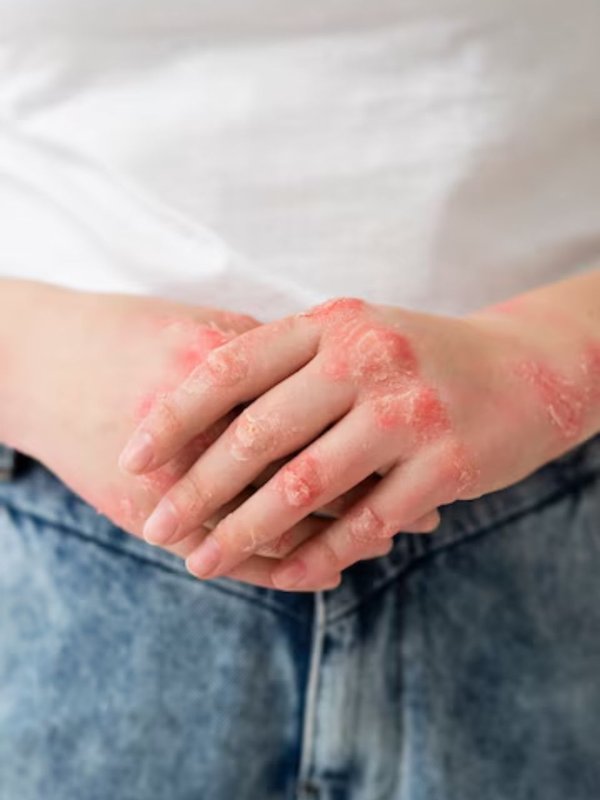 fungal infection during rainy season