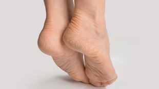 Aloevera for cracked heels