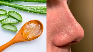 blackhead removal on nose