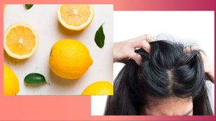 scalp infection home remedies with lemon