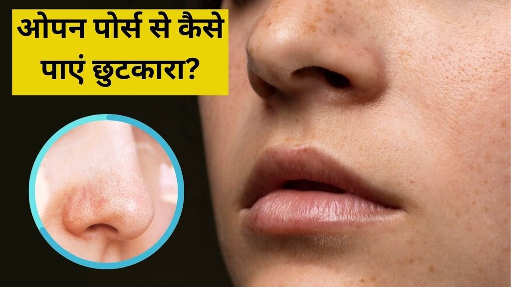 Open Pores । Open Pores Remedies । Skin Care