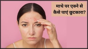 Forehead Acne । Forehead Acne Treatment । Forehead Pimple Treatment