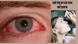 vision,tired eyes,stye,strong vision,eye problem,dry eyes,conjunctivitis,Eyeflu symptoms, Eyeflu cure, Eyeflu home remedies,आई फ्लू, आई फ्लू के लक्षण,