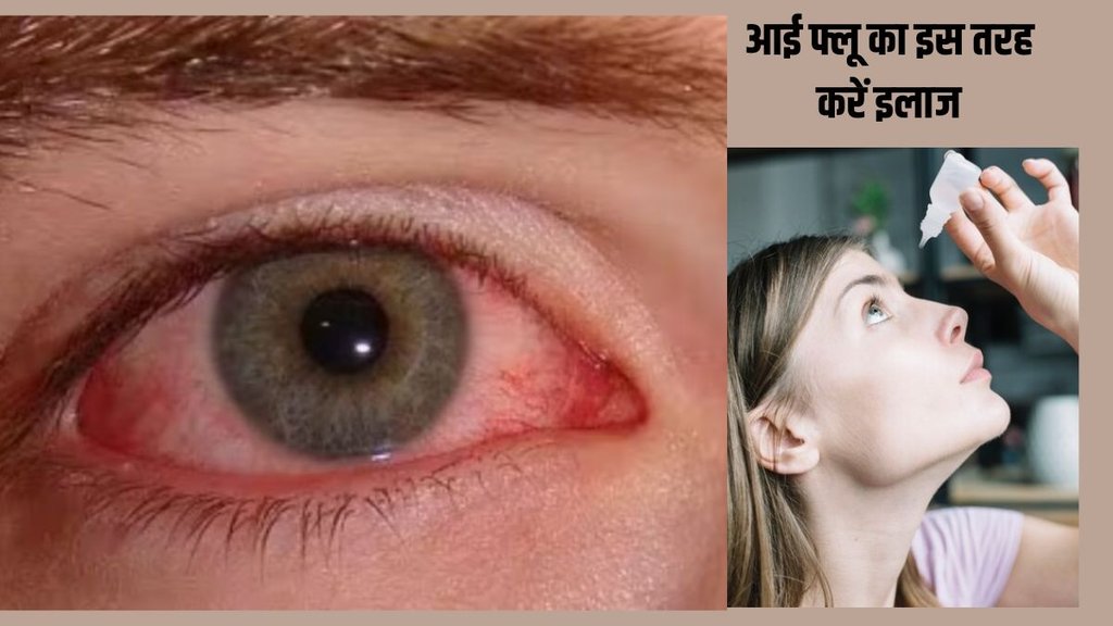 vision,tired eyes,stye,strong vision,eye problem,dry eyes,conjunctivitis,Eyeflu symptoms, Eyeflu cure, Eyeflu home remedies,आई फ्लू, आई फ्लू के लक्षण,