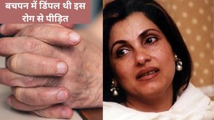 prevention, what is leprosy that Dimple Kapadia once suffered from leprosy, Dimple Kapadia, leprosy, Mycobacterium leprae, skin, nerves, eyes, respiratory droplets,