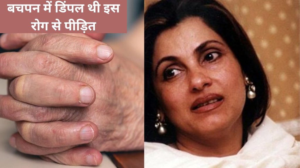 prevention, what is leprosy that Dimple Kapadia once suffered from leprosy, Dimple Kapadia, leprosy, Mycobacterium leprae, skin, nerves, eyes, respiratory droplets,