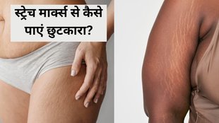 Stretch Marks । Home Remedies for Stretch Marks । Stretch Marks Removal Tips