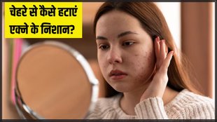 Acne Treatment । how to remove acne marks । How to treat acne
