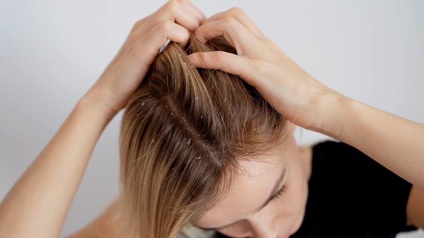 Camphor and cloves for itchy scalp: अगर आपके सिर खुजली होती रहती है तो ये स्कैल्प इंफेक्शन की वजह से हो सकता है। ऐसे में आप इन दोनों को मिलाकर नारियल तेल में मिलाकर लगा सकते हैं। इससे स्कैल्प की खुजली कम हो जाती है। (P.C. Freepik)