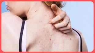 Back Acne Home Remedies