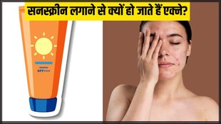 Sunscreen । Sunscreen and acne । Right way to apply Sunscreen
