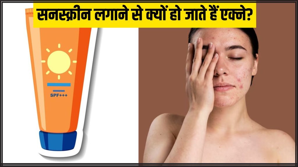 Sunscreen । Sunscreen and acne । Right way to apply Sunscreen