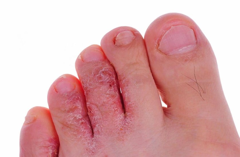 Camphor and cloves for fungal infection: अगर आपको दाद-खुजली जैसी समस्या हो रही है ऐसे में भी आप इन दोनों को सरसों के तेल में पकाकर उन जगहों पर लगा सकते हैं जहां इंफेक्शन हो। (P.C. Freepik)