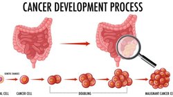Colon Cancer: युवाओं में क्यों बढ़ रहा है कोलोन कैंसर का खतरा, 5 लक्षणों को समय पर पहचान लेंगे तो बड़ी मुसीबत से बच जाएंगे