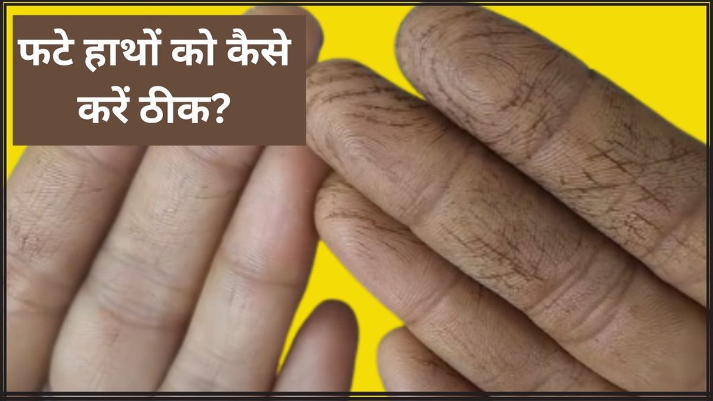 Crack Hands । Home remedies for crack hands । dry hands