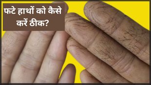 Crack Hands । Home remedies for crack hands । dry hands