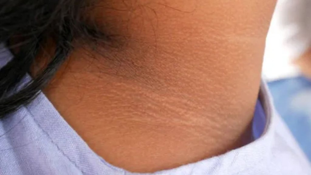 Black neck causes, dark neck causes, dark neck treatment, Gardan Ke Kalepan Ka Karan, skincare, darkness on the neck, Dark neck can be a sign of these 5 serious,