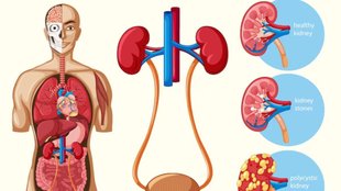Kidney stone symptoms , kidney stone signs , four signs indicate stones in your kidney , kidney stone , kidney stone treatment , how to cure kidney stone