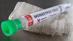 monkeypox virus | vaccine | serum institute |