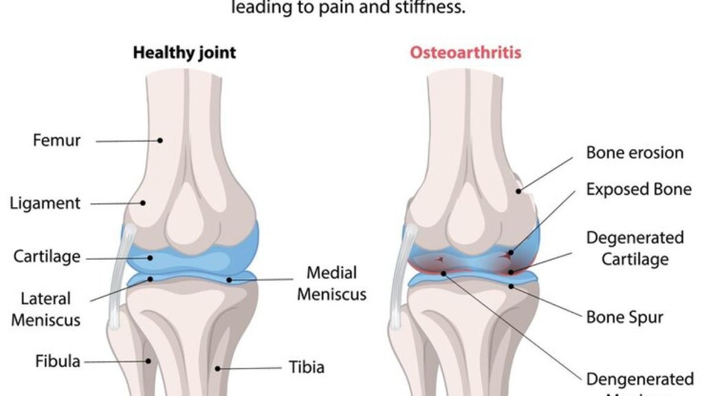 knee osteoarthritis, osteoarthritis management, non-surgical treatments, exercise, weight management, pain relief, knee pain, joint replacement, arthritis guidelines
