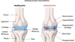 घुटनों के दर्द का नॉन सर्जिकल इलाज, अपनाएं ये शानदार तरीके, पेन हो जाएगा छूमंतर