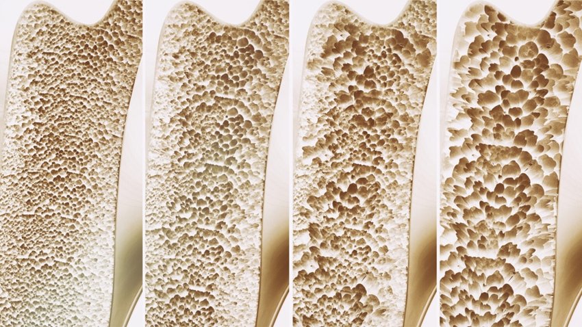 Acid Reflux Relief