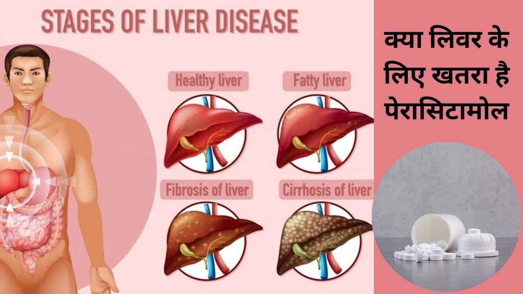 Paracetamol Side Effects,Paracetamol poisoning, paracetamol, painkiller,liver damage,acute hepatotoxicity,acetaminophen, पैरासिटामॉल के साइड इफेक्ट,